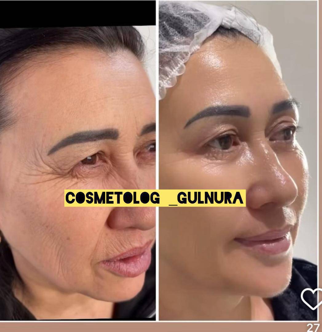 Муздак плазма - оорусуз , ийнесиз жашаруу !
🔥 АТАЙЫН СУНУШ — болгону 1500 сом!
Процедура эмне кылат:
• Майда бырыштарды тегиздейт
• Кара тамандарды азайтат(гусиные лапки)
• Терини бекемдейт жана толмочтойт
• Тонусту жана текстураны жакшыртат
• Сергектик жана жаркыроо кошот
Майлуулукту азайтат
Теринин өңүн жана текстурасын тегиздейтТаасири акырындык менен күчөйт , Маникюр-500с,парафин рук- 300 с,наращивание ресниц-800 с,Очпос макияж  2 жылдык- каш , ооз,-1500 с Акция!Бет тазалоо-500 с,шугаринг! Инстаграм катталыныз: Cosmetolog _gulnura