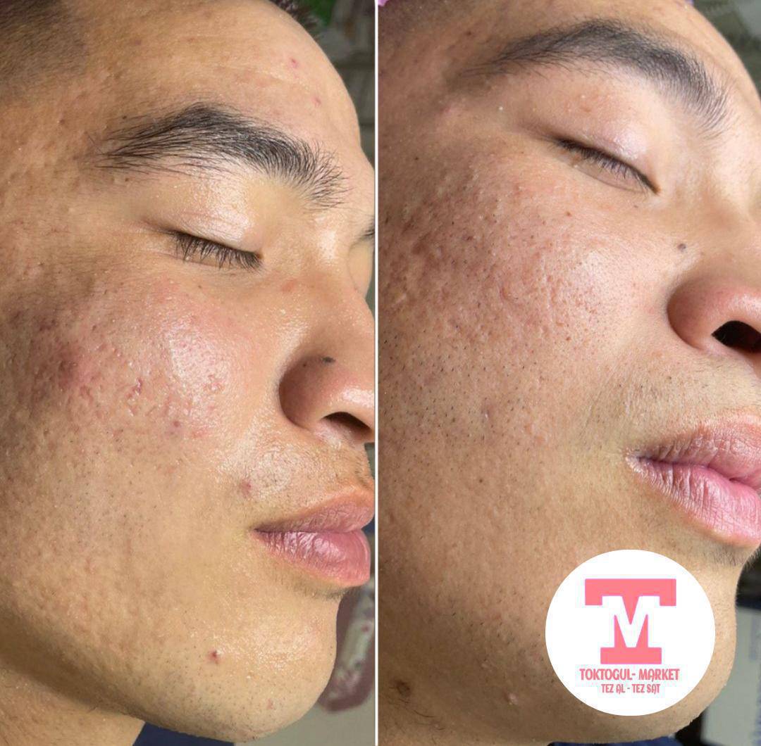 Урматтуу айымдар ж/а мырзалар! Ультразвук 9 в 1  бет тазалоого келиниздер!болгонуу акция менен 500 с!
✨ Ультраун скраббери – өлгөн тери клеткаларын жана кирлерди кетирет
✨ Иондоштуруу – сыворотканын сиңүүсүн күчөтөт
✨ Микроток – ​​ бетти тартат  жана көтөрот 
✨ Фонофорез – терең нымдаштырат
✨ Муздак/Жылуу – шишикти азайтат
✨ Вибрациялык массаж – тонусту жана кан айланууну жакшыртат
✨ LED жарыгы – сезгенүүнү азайтат
Пилинг и маска бекер !