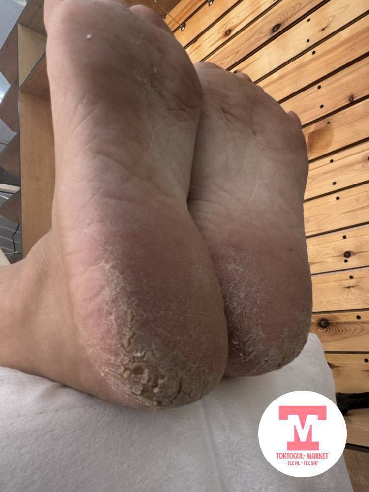 •Этке батып оскон тырмак
•жарылган таман, сөөл
•тырмактагы грибок 
Жана ушц сыяктуу койгой кыйнаса медициналык билими бар подолог жардам берет 0755710414
@eliza_medpodolog