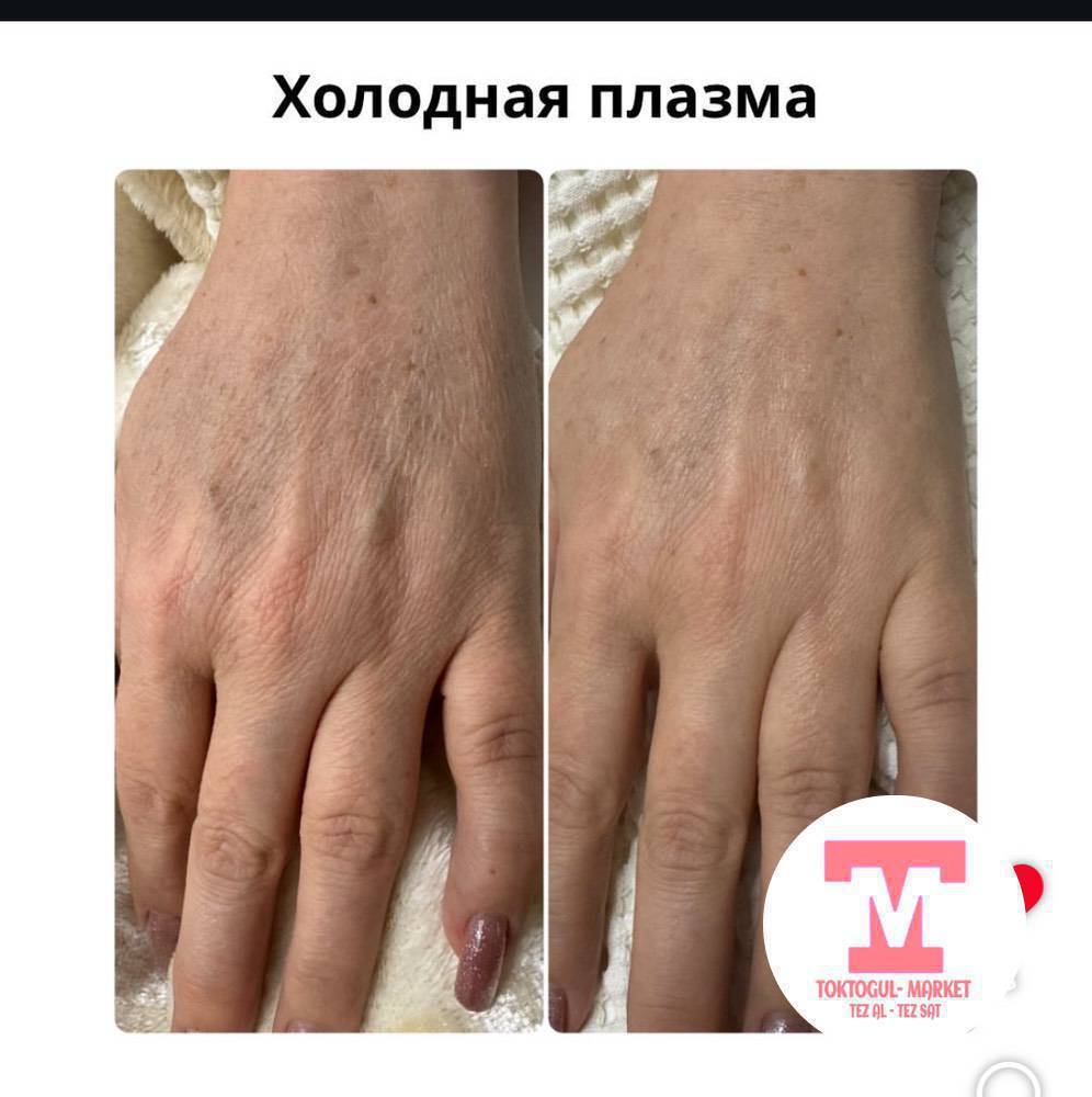 Муздак плазма — ийнесиз жана ботоксуз жашаруу!
Майда жана терен бырыштар тартылат!Тазалайт, бекемдейт, пигментти жана сезгенүүнү кетирет.угри, кара точкаларды жок кылат!
Бетке, кабакка,эринге ылайыктуу! 
Ультра чистка лица -500 с! Акция!
Наращивание ресниц -500 с! 800 с!
Каш, Ооз макияж 2 жылга -1300 с!
Маникюр -500 с!
Инстаграм баракчабыз! 👇👇👇
https://www.instagram.com/cosmetolog_gulnura?igsh=MXN4bGxhcXMyeXZpMA%3D%3D&utm_source=qr
