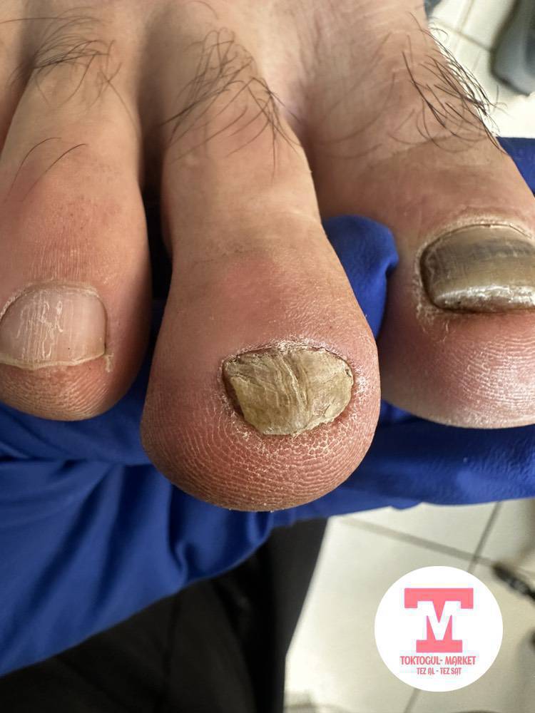 Тамандын жарылуусу, тырмактын этке сайылып осуусу, мозоль, бородавка, грибок кыйнап жатса 
Медициналык билими бар подолог жардам берет