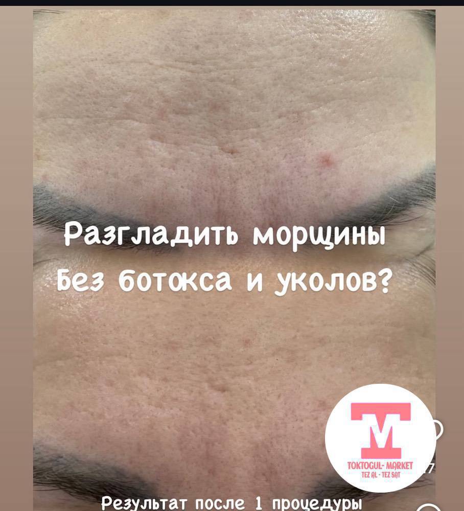 Урматтуу айымдар, жаны инновационный ийнесиз метод  МУЗДАК ПЛАЗМА апаратная процедура менен беттеги кургак, бырыш түшүп, тактар көп болуп жатса сертифицированный КОСМЕТОЛОГГО келиниздер.Муздак плазма Терини жашартат ,Пигментацияны жана жөргөмүш тамырларды кетирет,Тешикчелерди тарылышат,угри жана исиркектерди дарылайт,
Беттин овалын чыңдап, бырыштарды азайтат , баасы 500 с ойдо!  МАНИКЮР -500 с!КИРПИК-500с! ЧИСТКА ЛИЦА-500с!КАШ - ООЗ  бойоо - 1500 с ,2 жылга  очпос макияж!  Дагы коп деген процедуралар бар,консультация беке!
Инстаграм Cosmetolog_gulnura