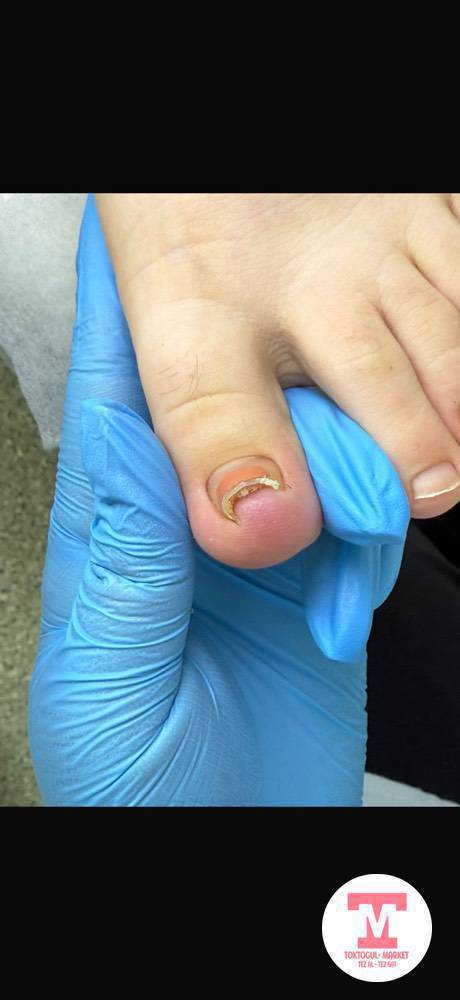 Тырмактагы грибок, этке сайылып оскон тырмак , мозоль, бородавка , тамандагы трещина жана ушул сыяктуу койгойлор болсо медициналык билими бар подолог жардам берет
Номер 0220034093, 0755710414