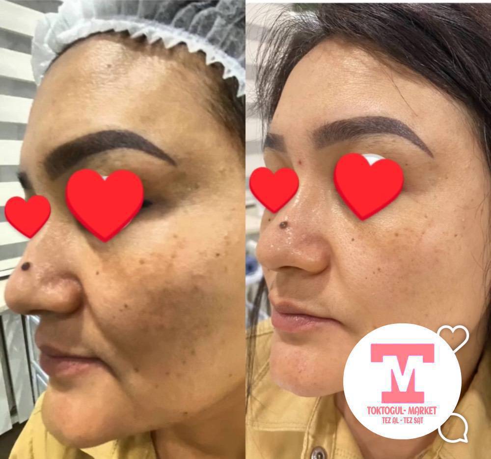 Муздак  плазма арзандатуу менен! ✨
Бырыштардан операциясыз ,уколсуз  жашартуу процедура!Муздак плазма менен дарылоо терини тартууга, бырыштарды азайтууга жана бетти жашартууга жардам берет.
🔥 Атайын сунуш! Кабак которуу, коз айланасы-1500 с!
Чеке -1300 сом!
Полный бетке-2500 с!