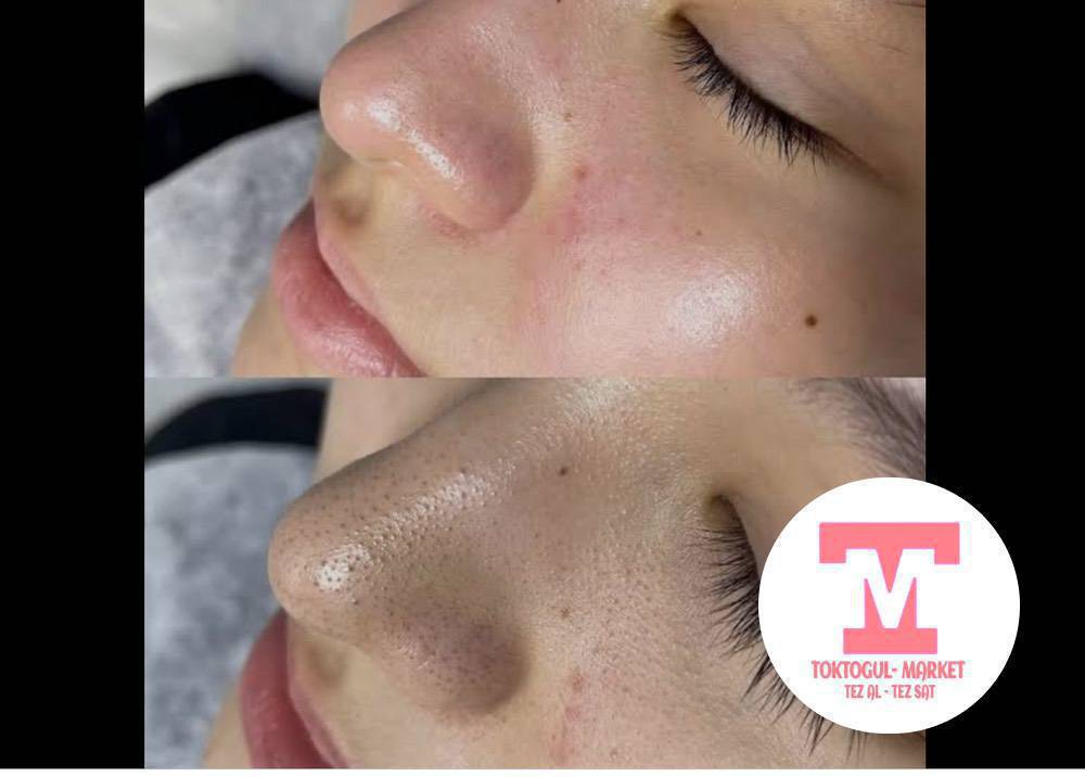 Бетти ультраүн менен тазалоо
Кызарууну же кыжырланууну сезбеген жылмакай, жаңы жана жаркыраган тери каалайсызбы?
УЗИ менен тазалоо - эң сонун чечим!
🌿 Процедура эмне кылат:
✔ Тери тешикчелерин акырын тазалайт
✔ Кара чекиттерди жана ашыкча майларды кетирет
✔ Теринин текстурасын тегиздейт
✔ Беттин өңүн жакшыртат
✔ Терини заматта жылмакай жана жаңы кылат
Баасы: 5️⃣0️⃣0️⃣ с