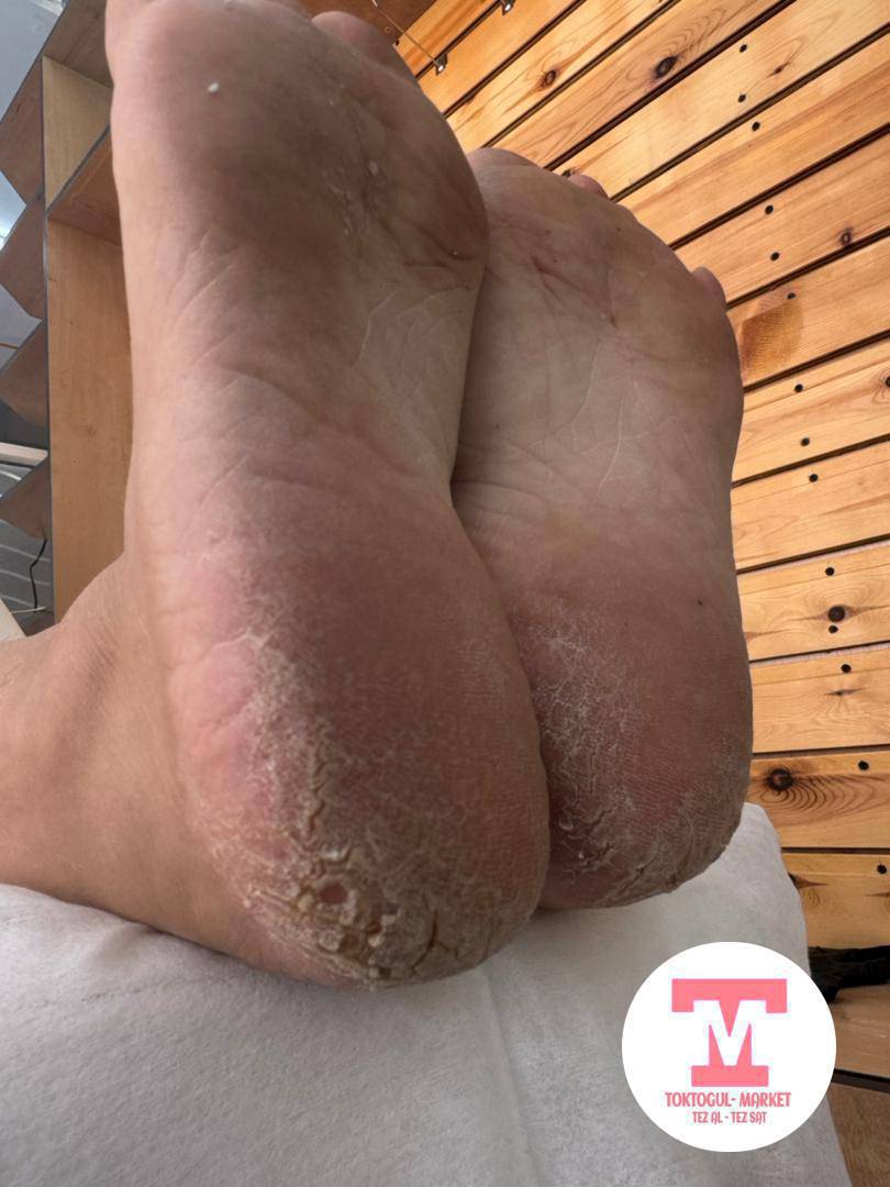 Тырмактагы грибок, этке сайылып оскон тырмак , мозоль, бородавка , тамандагы трещина жана ушул сыяктуу койгойлор болсо медициналык билими бар подолог жардам берет 0755710414